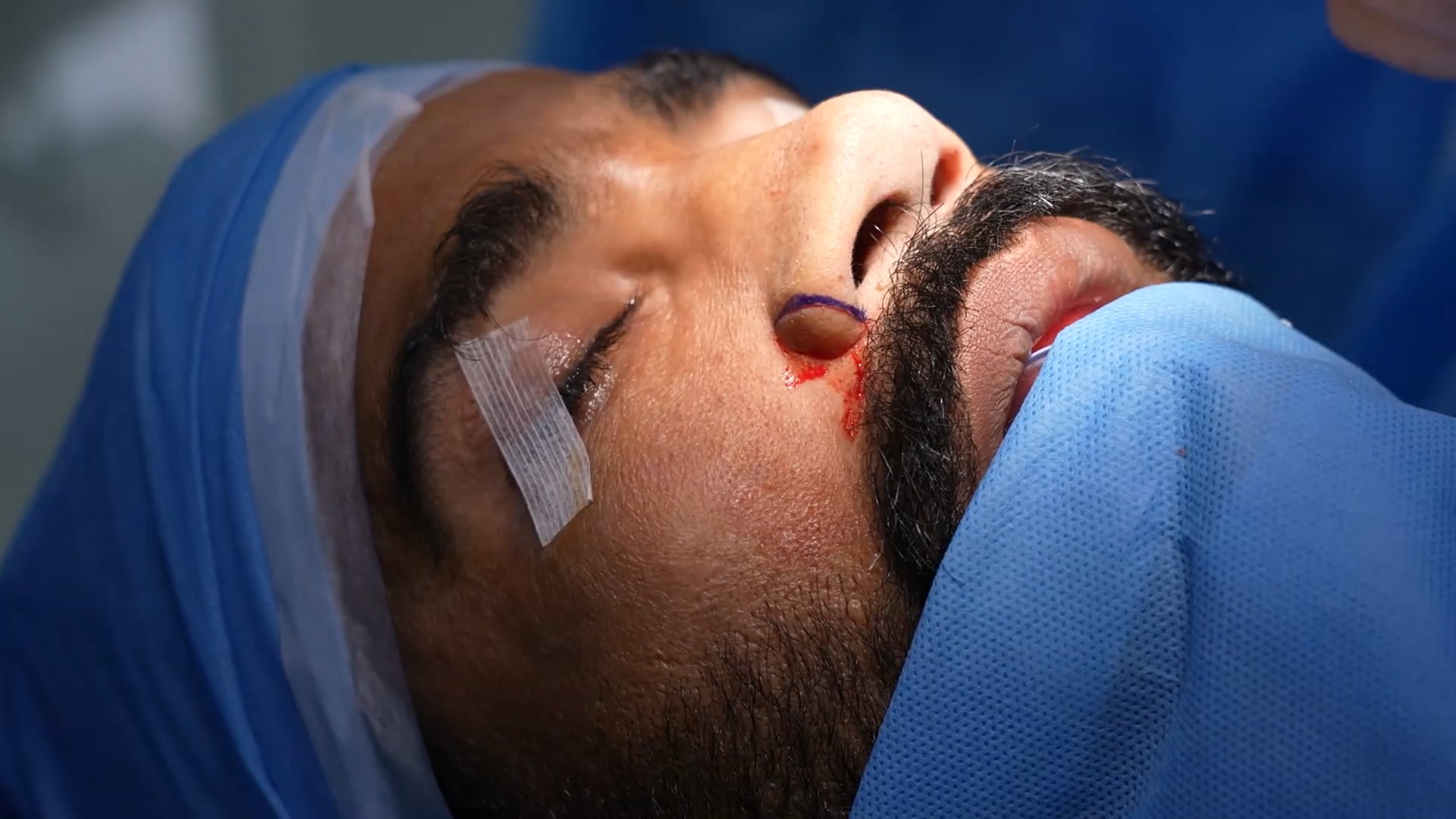 Flared nose correction surgery